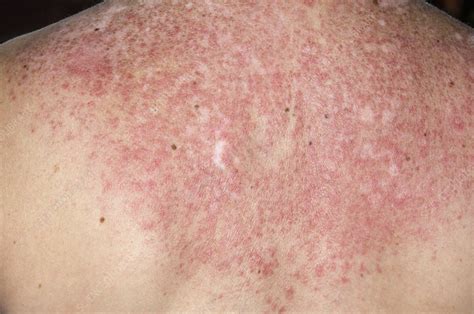 Lupus rash on back triggered by sun - Stock Image C006/9165 - Science Photo Library