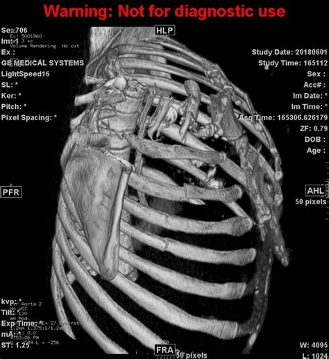 Grade 4 Liver Laceration after Cardiopulmonary Resuscitation: A Case Report - Asploro Open ...