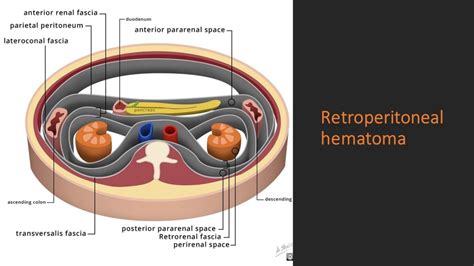 Retroperitoneal hematoma – NephroPOCUS