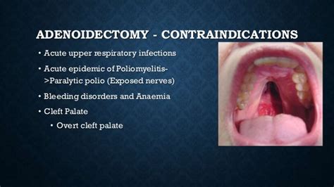 Adenoidectomy and tonsillectomy