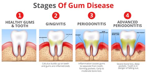 Learn About Gum Disease | Gum Infection Stages | Periodontitis Treatment