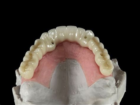 6 Types of Dental Restorations