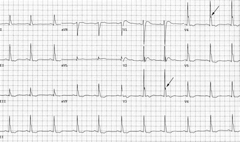 Hypercalcaemia ECG changes • LITFL • ECG Library