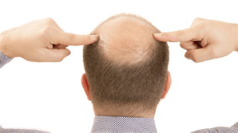 What is Androgenic Alopecia? - Symptoms, Causes and Treatment