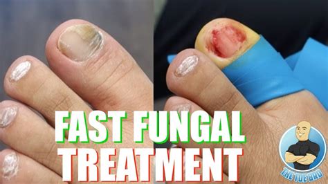 does toenail fungus look like - Toenail Fungus Treatment | Toenail Fungus Treatment