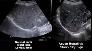 Liver Ultrasound Normal Vs Abnormal Image Appearances C... | Doovi