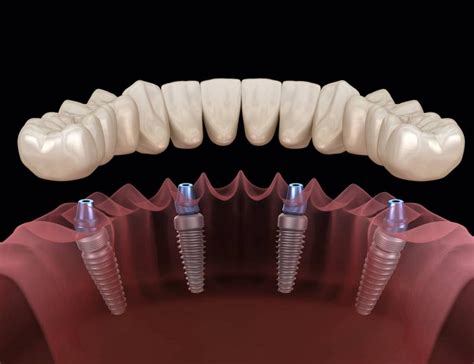 The Different Types of Dental Implants Available - Fabrioberto.com