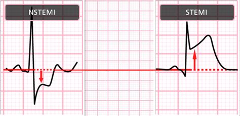 CVT Mohd Farid: ECG & Echocardiography Case Study Chronic Myocardial Infarction-Credit Cardio ...