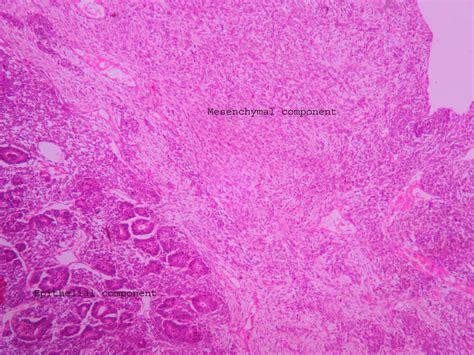 Wilm’s tumor – UG slide – Histopathology.guru