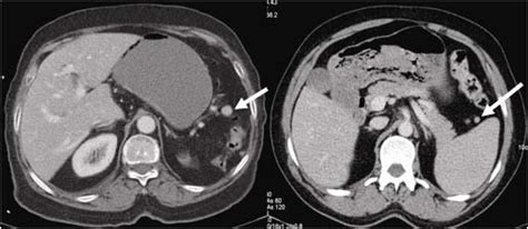 Contrasted axial CT: a. Accessory spleen is monitored, b. Accessory... | Download Scientific Diagram