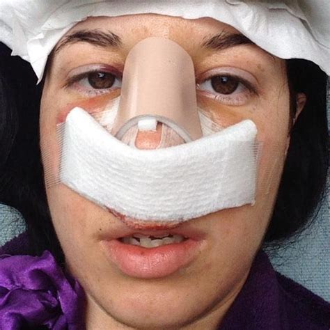 Correcting A Deviated Septum With Surgery Photos » Rhinoplasty: Cost ...