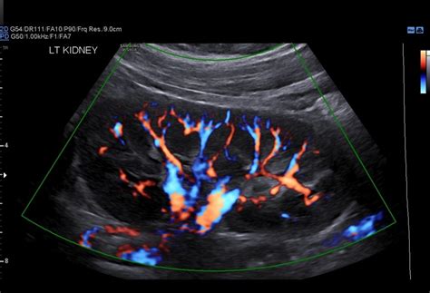 Renal Scan - Women's Imaging