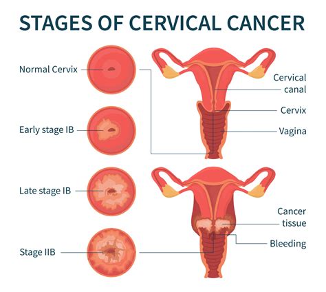 Stages of cervical cancer white infographic scheme 3145603 Vector Art ...