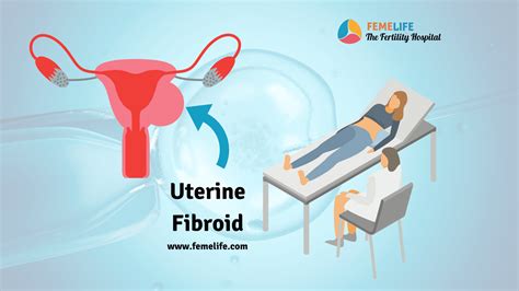 Uterine Fibroid Size Can Affect Your Fertility - FEMELIFE