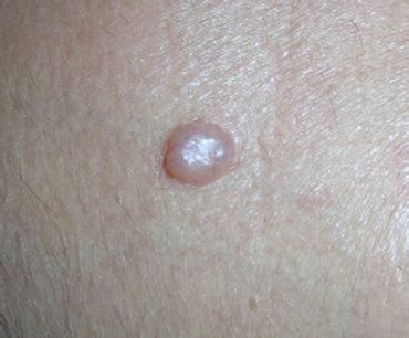 How Fast Nodular Melanoma Goes from Flat to Pencil Eraser Height — Scary Symptoms