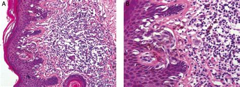 Melanocytic Nevus Histology