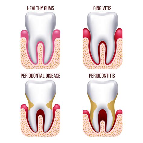 Stages of Periodontal Disease | Park Cities Periodontics, Dallas TX