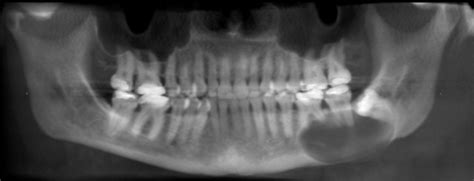 Radicular Cyst; Periapical Cyst; Periodontal Cyst, Apical