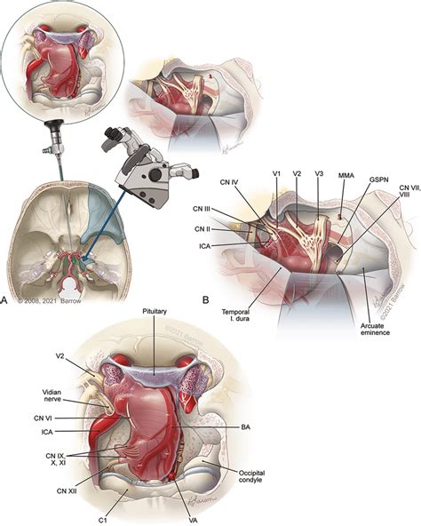 Schematic illustration of petroclival meningioma (PCM) best approached... | Download Scientific ...