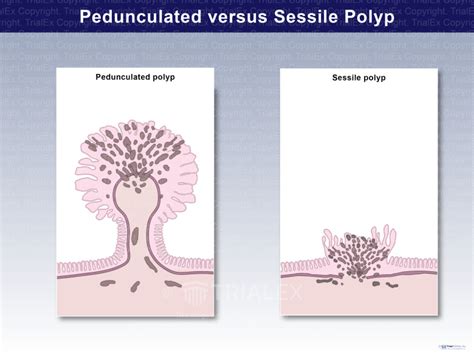 Pedunculated versus Sessile Polyp - TrialQuest Inc.