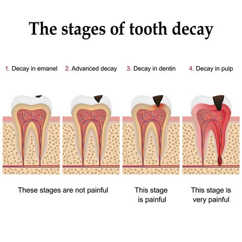 Stages of Tooth Decay | Cedar Creek Dental