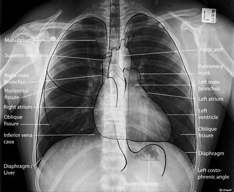 Chest X Ray Ap View Positioning at Mario Williamson blog