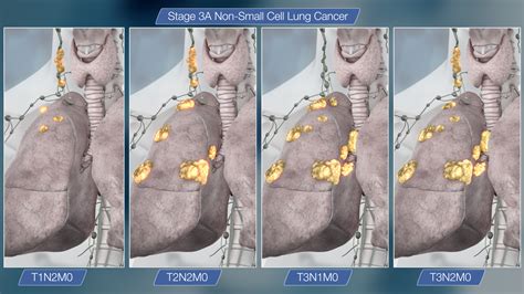 Stage 3 Small Cell Carcinoma Lung Cancer - CancerWalls