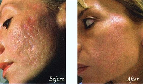 best treatment for acne scars and large pores: acne scars treatment before and after