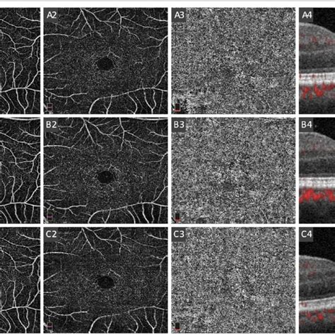 Sketch of automatic retinal layers segmentation produced by AngioVue... | Download Scientific ...