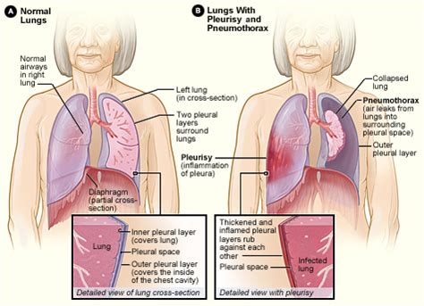 Wikizero - Pleurisy