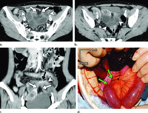 Broad ligament hernia in a 58-year-old woman with a 1-day history of ...