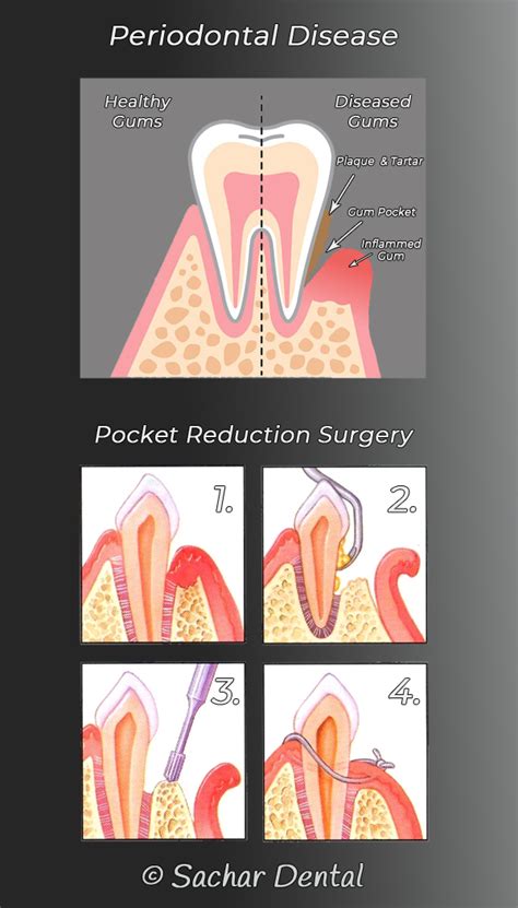 Periodontal Surgery NYC