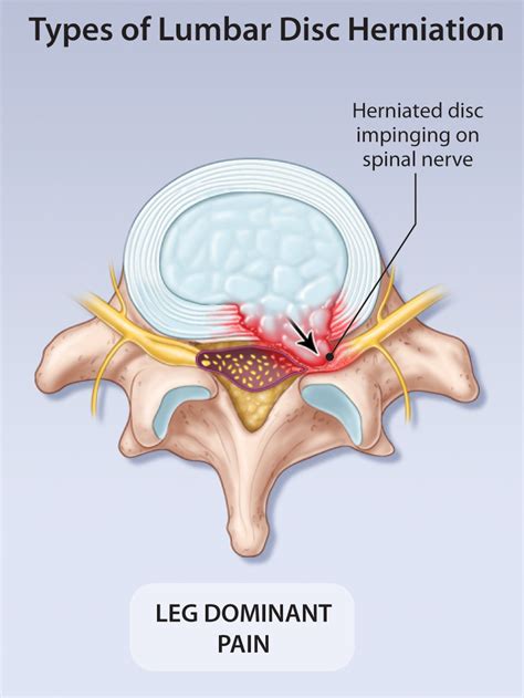 Current Management of Symptomatic Lumbar Disc Herniation | HealthPlexus.net