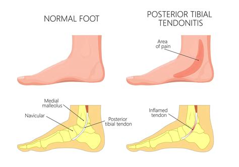 Posterior Tibial Tendonitis - Symptoms, Causes & Treatments