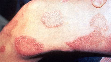 LEPROSY – Dermatology Conditions and Treatments