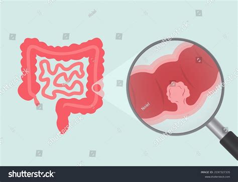 Colonoscopy Intestine Polypectomy Procedure Removal Polyp Stock Illustration 2197327335 ...