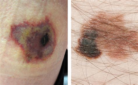 Is That A Brown Recluse Spider Bite Or Skin Cancer? | Health News Florida