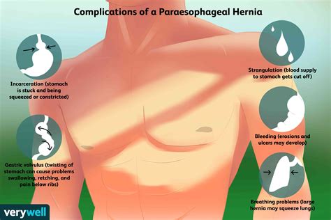 Paraesophageal Hiatal Hernia: Symptoms and Treatments