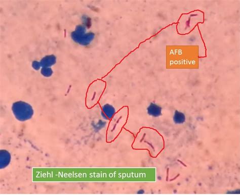 Ziehl -Neelsen stain of sputum : Principle, Procedure and Result Interpret