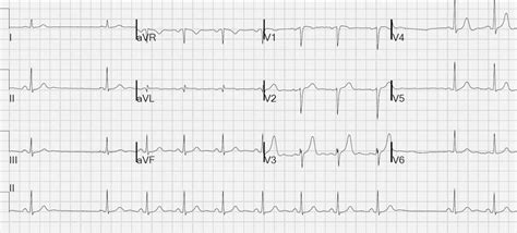 sinoatrial-block – SCOPE