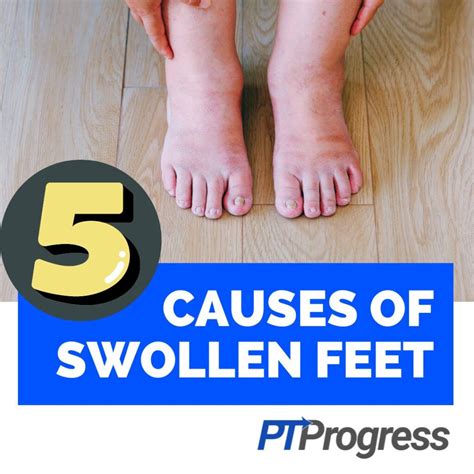 What Causes Swollen Feet