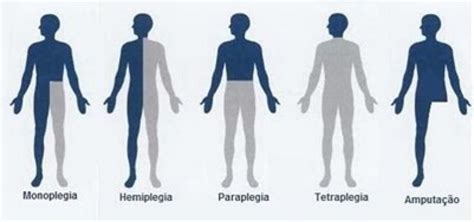 Types of Plegia...