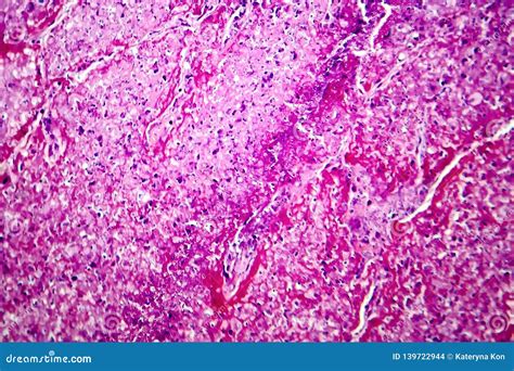 Tuberculosis Granuloma. Langhans Cell Royalty-Free Stock Photography ...