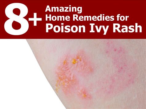 8+ Amazing Home Remedies for Poison Ivy Rash | Patterson Greenhouses