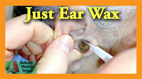 Ear Wax Removal By Doctor