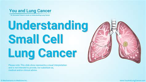 Understanding Small Cell Lung Cancer