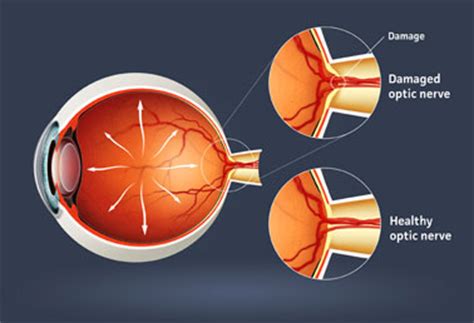 Optic Nerve Injuries; Optic Nerve Trauma; Optic Neuropathy, Traumatic; Second Cranial Nerve Trauma