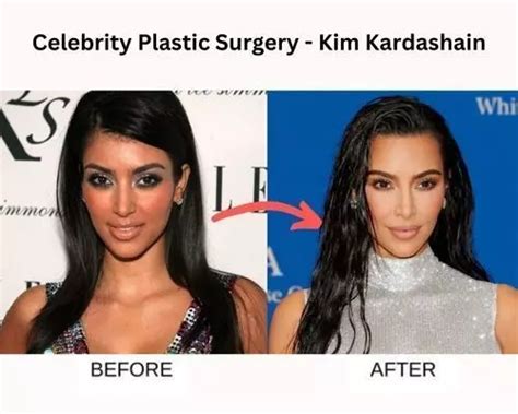 celebrities before and after plastic surgery