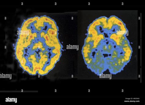 A pair of PET scans showing normal (left) and reduced (right) brain Stock Photo: 9150868 - Alamy