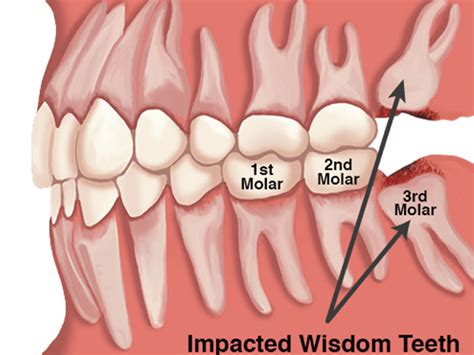 Wisdom Teeth: What they are and why to remove them – Meyer Clinic